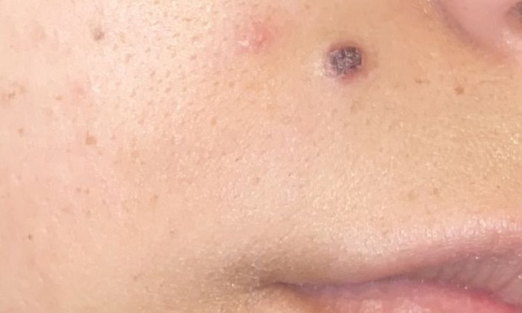 Seduta laser e neo viso - 81418