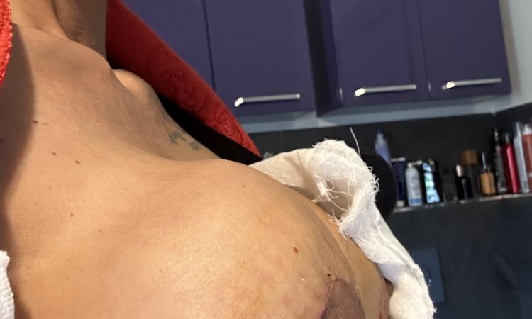 A due settimane dopo mastopessi con protesi il seno lo vedo deforme - 81442