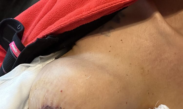 A due settimane dopo mastopessi con protesi il seno lo vedo deforme - 81443