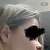 Ho effettuato filler labbra ieri