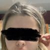 Ho effettuato filler labbra ieri