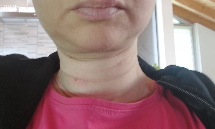 Pelle in eccesso sul collo - 81493
