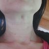 Pelle in eccesso sul collo