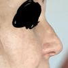 Gobbetta dorso dopo rinosettoplastica