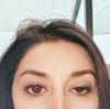 Filler guance e botox fronte