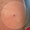 Neo sul tallone da 1 anno