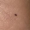 Neo sul tallone da 1 anno