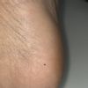 Neo sul tallone da 1 anno