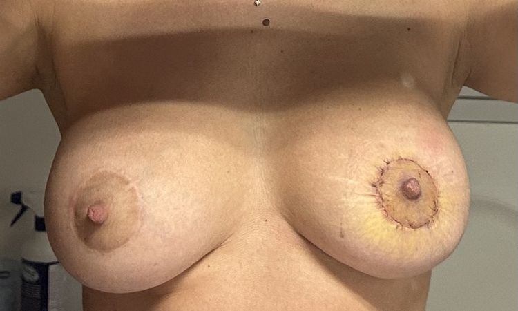 Cicatrice periareolare già operata - 81968