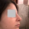 Rinosettoplastica e narici asimmetrice