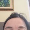 Segno tipo graffio nella ruga glabellare post filler