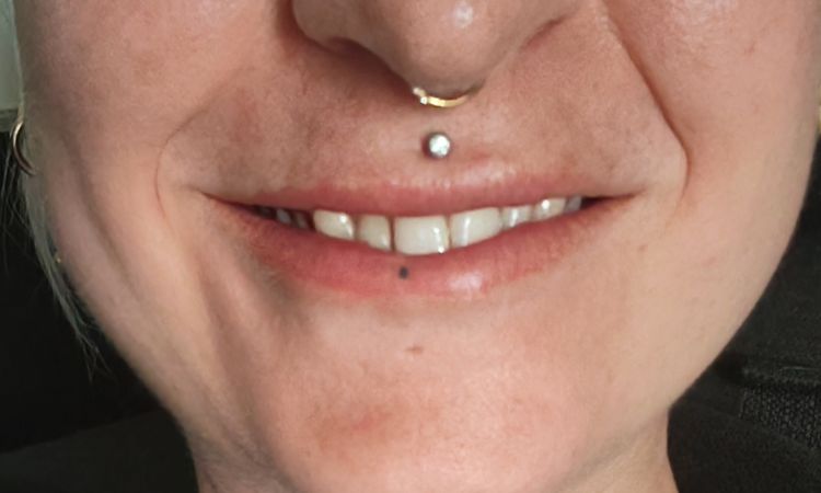 Labbro bloccato dopo iniezione botox - 82057