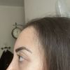 Ho fatto una rinoplastica ma vedo una gobba