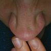 Solco naso dopo cortisone rinoplastica