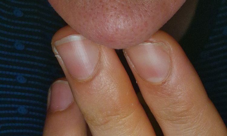 Solco naso dopo cortisone rinoplastica - 82122
