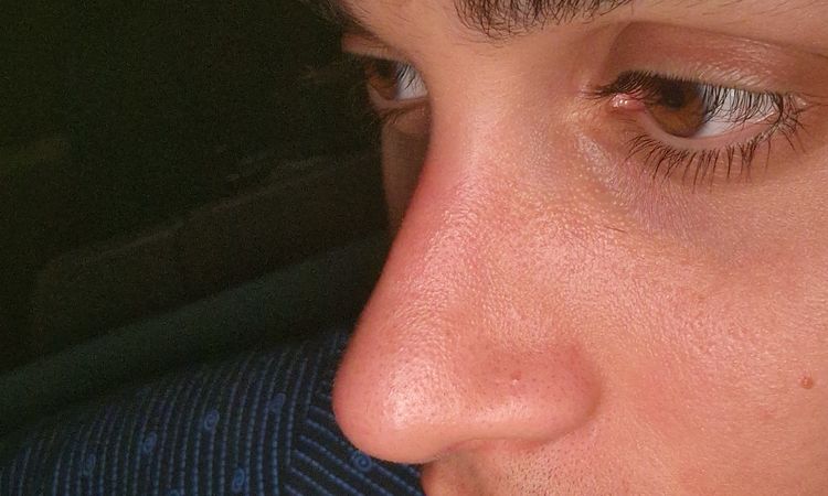 Solco naso dopo cortisone rinoplastica - 82124