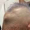 Bruciatura su pelle da decolorazione