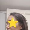 Narici completamente diverse post rinosettoplastica