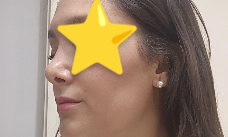 Narici completamente diverse post rinosettoplastica - 82188