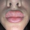 Gonfiore e arrossamento a tre settimane dal filler