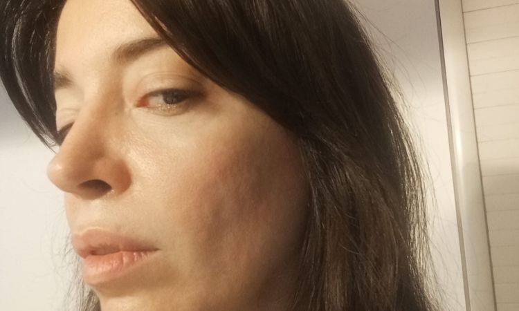 Problema profhilo sul viso - 82459