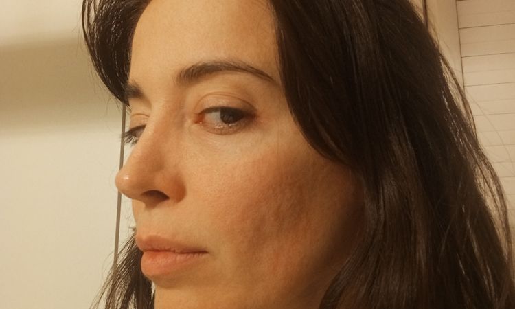 Problema profhilo sul viso - 82461