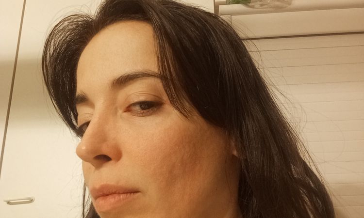 Problema profhilo sul viso - 82462