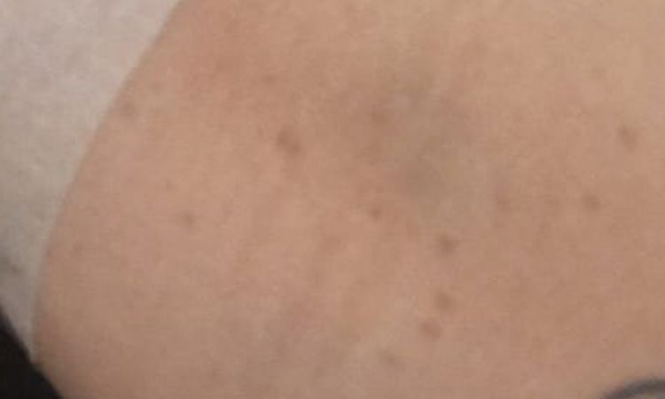 Macchie solari su spalle, schiena e gambe - 82522