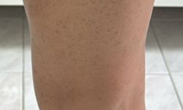 Macchie solari su spalle, schiena e gambe - 82524