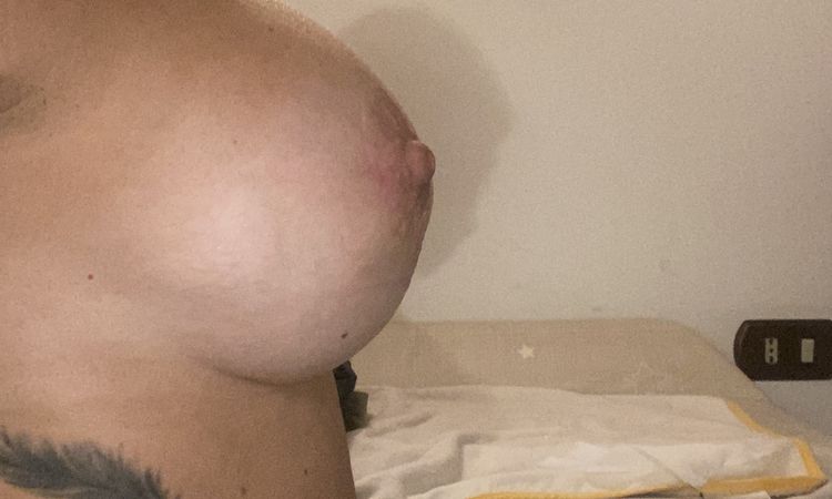 Seno deformato che poi torna normale - 82593