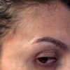 Filler tempie, irregolarità palpebra gonfia e occhiaie scure