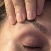 Filler tempie, irregolarità palpebra gonfia e occhiaie scure