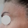 Filler tempie, irregolarità palpebra gonfia e occhiaie scure