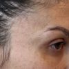 Filler tempie, irregolarità palpebra gonfia e occhiaie scure