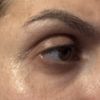 Filler tempie, irregolarità palpebra gonfia e occhiaie scure