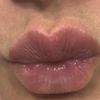 Pallina filler nel prolabio post trattamento