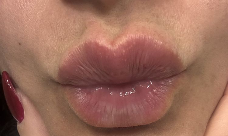 Pallina filler nel prolabio post trattamento - 82836