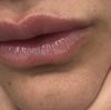 Pallina filler nel prolabio post trattamento