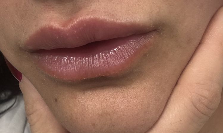 Pallina filler nel prolabio post trattamento - 82837