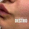 Pallina filler nel prolabio post trattamento