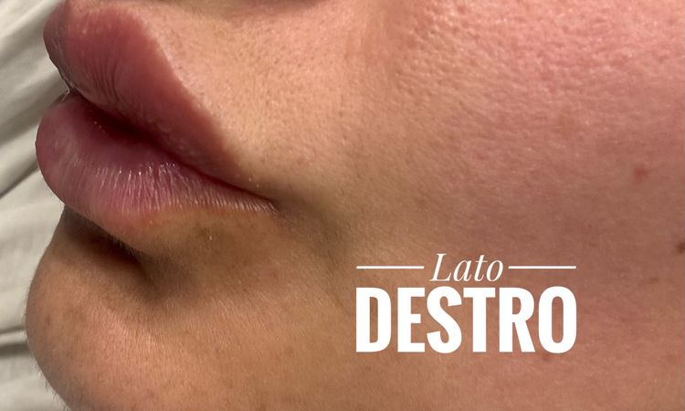 Pallina filler nel prolabio post trattamento - 82838