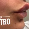 Pallina filler nel prolabio post trattamento