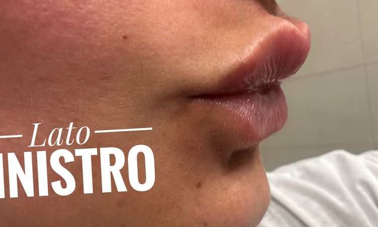 Pallina filler nel prolabio post trattamento - 82839