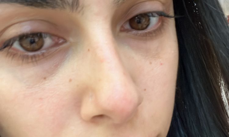 Naso rosso dopo 5 mesi dal rinofiller - 82874