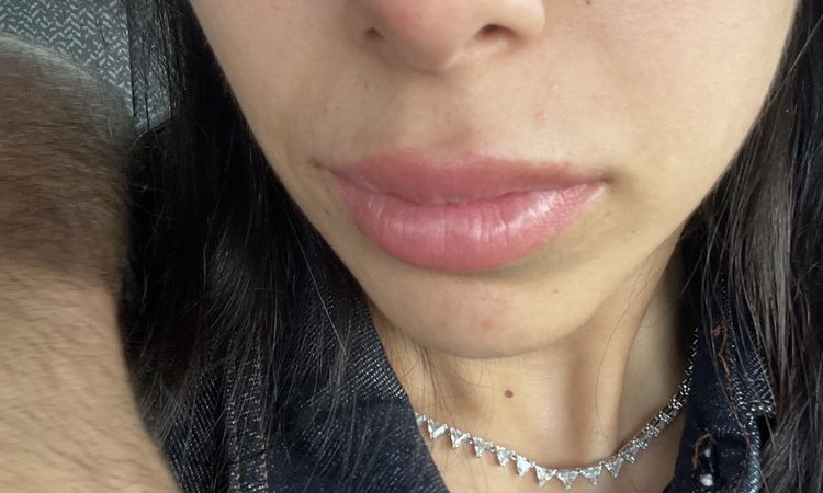 Naso rosso dopo 5 mesi dal rinofiller - 82875