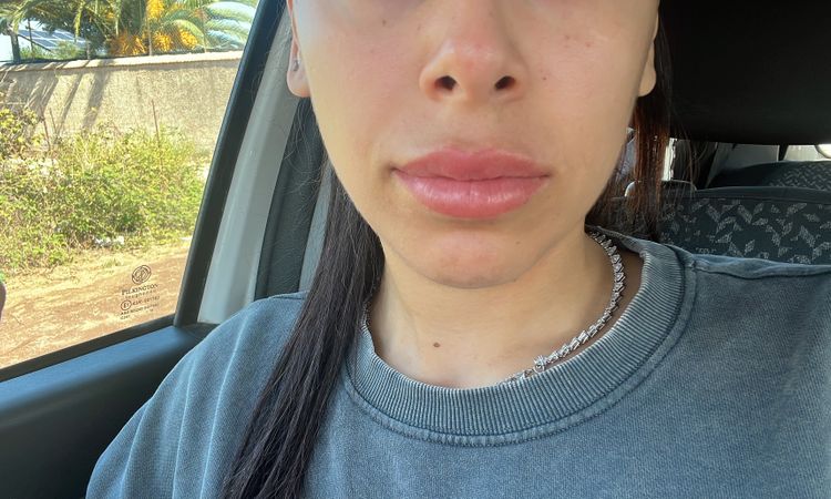 Naso rosso dopo 5 mesi dal rinofiller - 82876