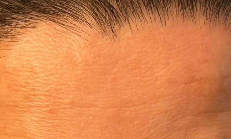 Azzalure o Vistabex, qual è la differenza e quale dura di più? - 82912