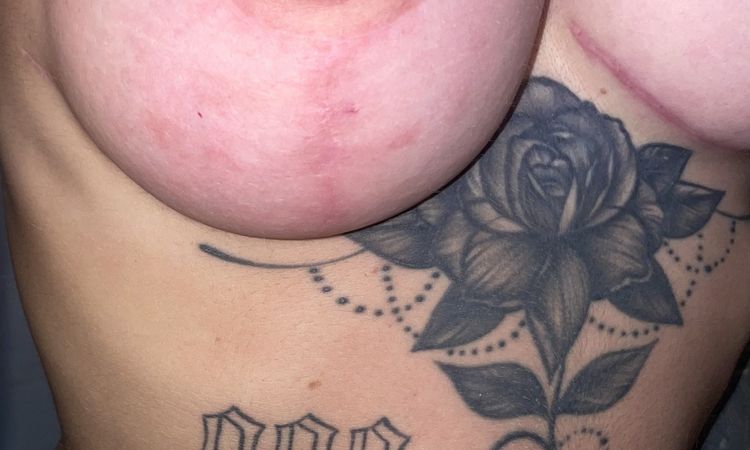 Mastopessi: intervento non soddisfacente - 82946