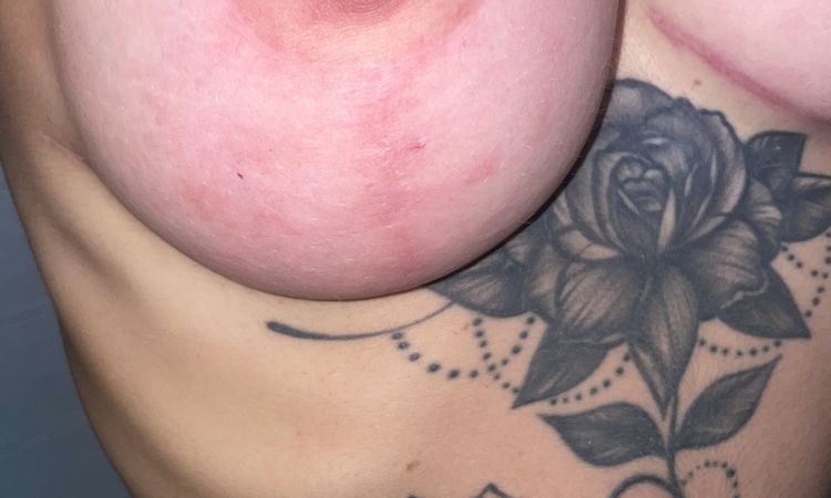 Mastopessi: intervento non soddisfacente - 82948