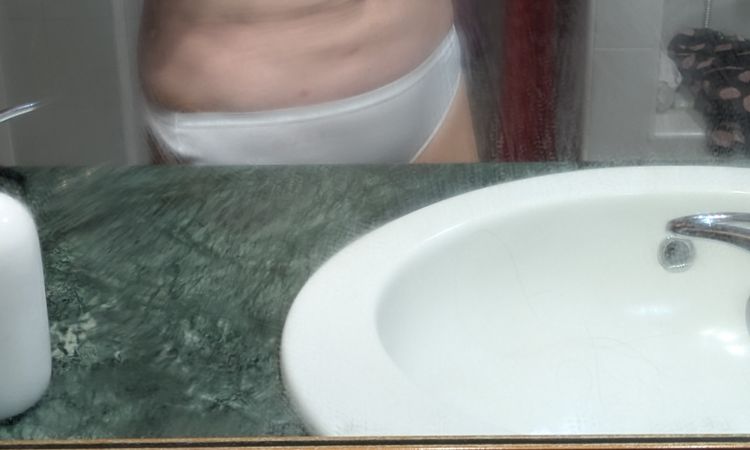 Solchi addome dopo lipofilling - 82978